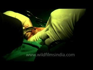Breast Fibroid removal surgery...