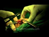 Removal of breast tumor by surgery...
