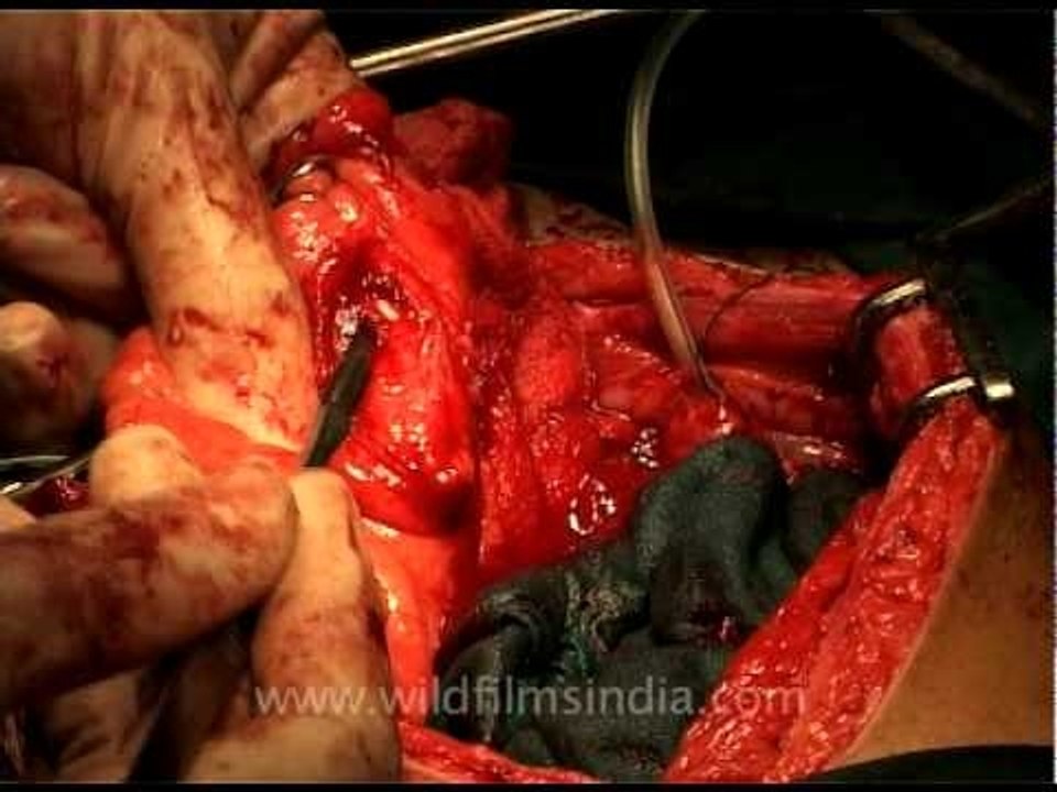 Inserting pipes during Laparoscopic surgery!