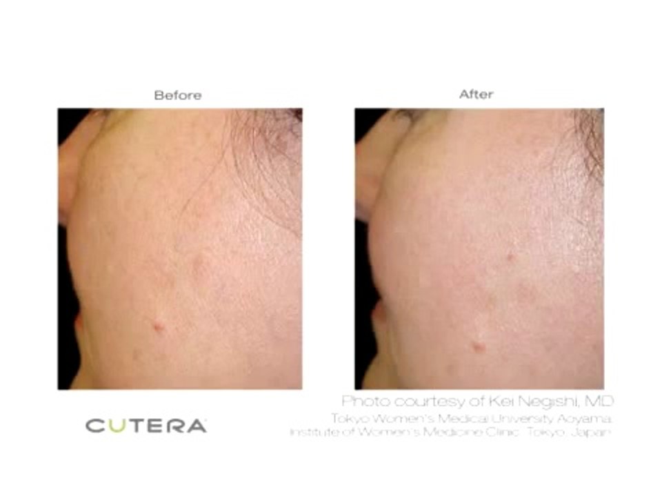 Face Lift Non Surgical Long Island Commack NY