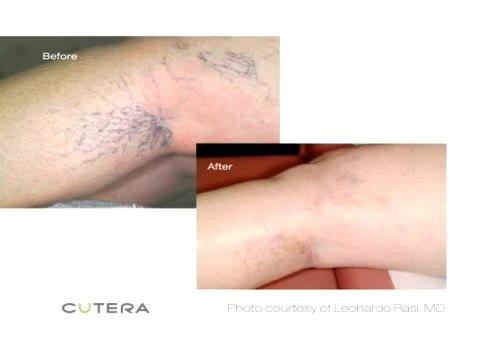 Laser Tattoo Removal Long Island Commack NY