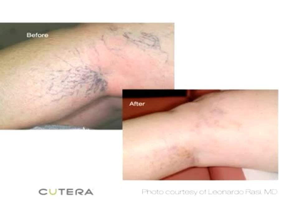 Laser Tattoo Removal Long Island Commack NY