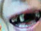 dents pourris