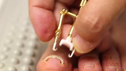 This Is By Far The Coolest Way For Dealing With Funky Toenails I Have Ever Seen