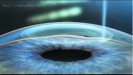 الليزك لتصحيح النظر مع د.متعب الشعيبي خلال 5 دقائق بـ 4300 ريال ( 0506102925 )