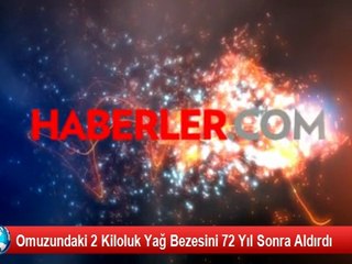 Omuzundaki 2 Kiloluk Yağ Bezesini 72 Yıl Sonra Aldırdı
