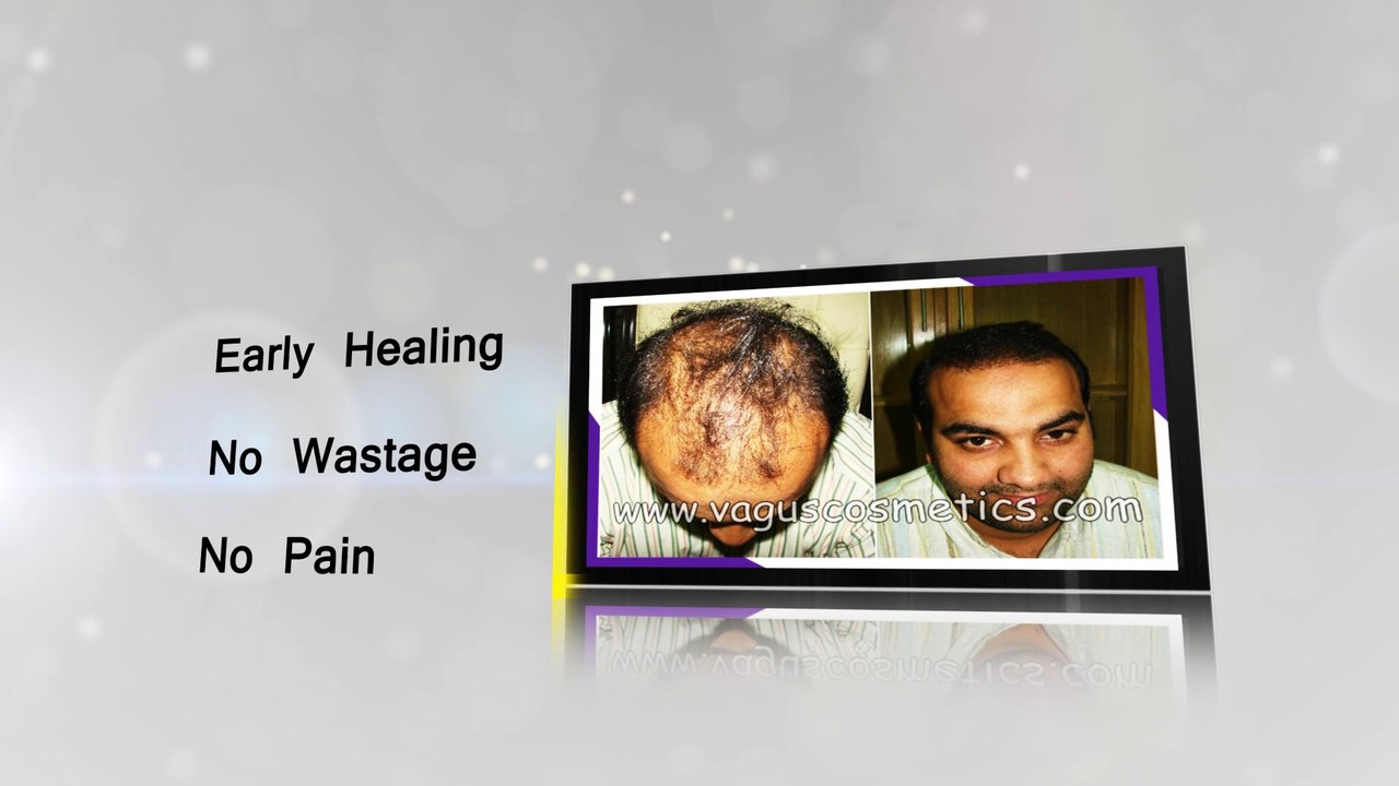 Hair Transplant Animation Revised