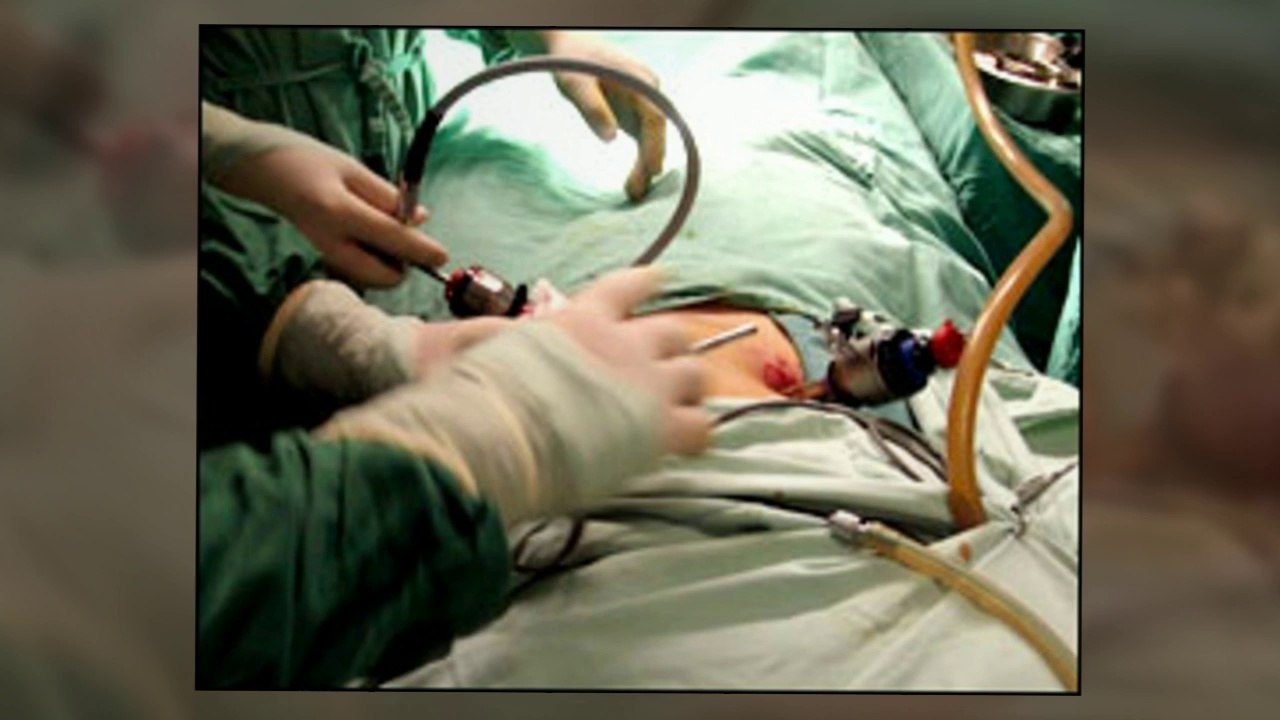 Weight Loss Surgery in Dubai, Gastric Balloon Dubai, Sleeve Surgery Dubai, Best Weight Loss Surgeon Dubai- Call +971 50 546 0715