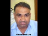 FUE Hair Transplant in Pakistan | FUE Hair Transplant in Islamabad | FUE Hair Transplant in Lahore | GHT Pakistan