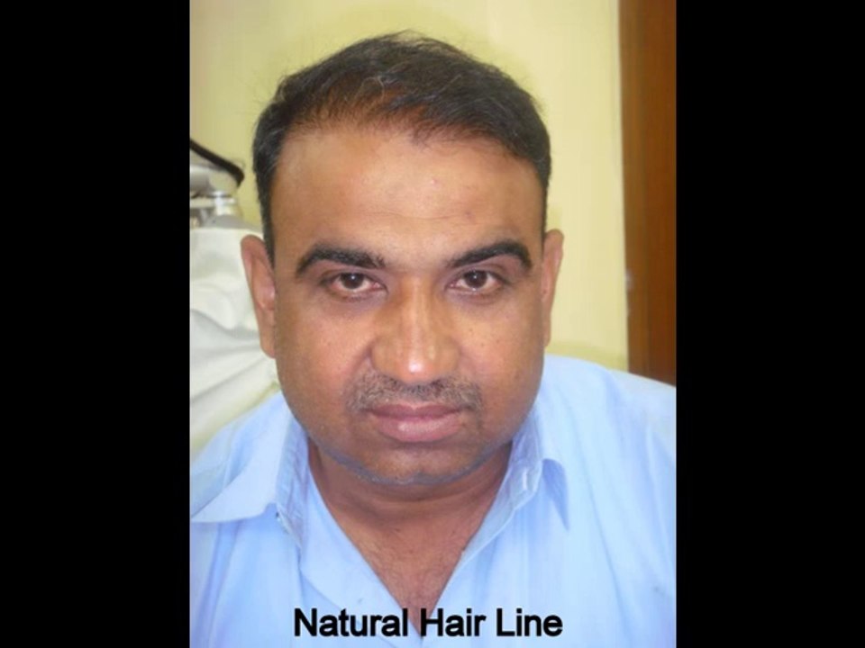FUE Hair Transplant in Pakistan | FUE Hair Transplant in Islamabad | FUE Hair Transplant in Lahore | GHT Pakistan
