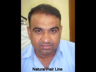 FUE Hair Transplant in Pakistan | FUE Hair Transplant in Islamabad | FUE Hair Transplant in Lahore | GHT Pakistan