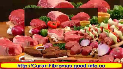 Como Curar Fibromas De Forma Natural, Miomas En El Embarazo, Mioma Gigante, Mioma Cervical