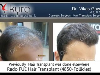 Hair Transplant in Punjab - Kyra
