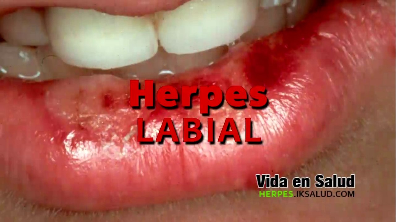 Cura para el herpes en la piel labial genital y zoster