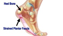 Podiatrist in Baltimore, Reisterstown and Owings Mills, MD - Heel Pain