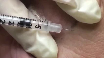 Botox Injection Technique Training