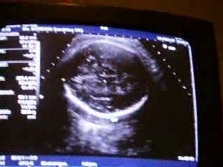 Paolo troisième Echographie