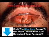 How To Get Rid Of Herpes Of The Mouth   How To Get Rid Of Herpes Naturally
