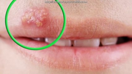 How To Cure Cold Sores On Lips Fast  Natural Treatment For Cold Sores (Fever Blisters)