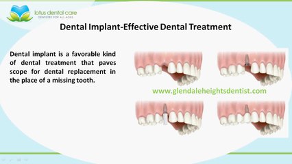 How Dental Implants can bring back your Sparkling Smile?