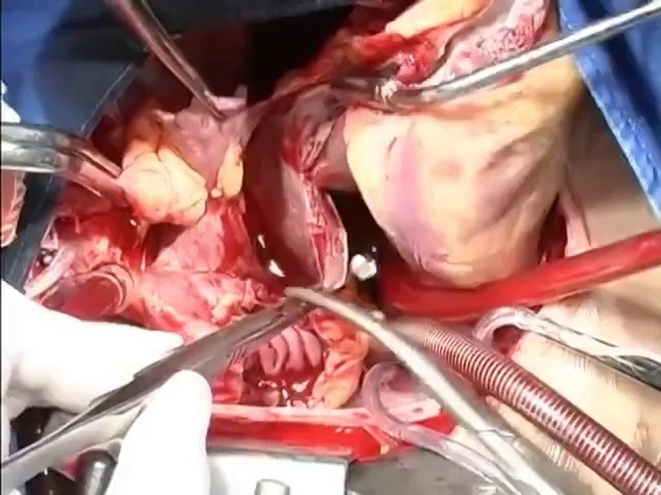 Heart Transplant Surgery Live Video
