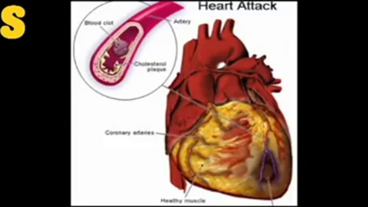How to avoid a heart attack
