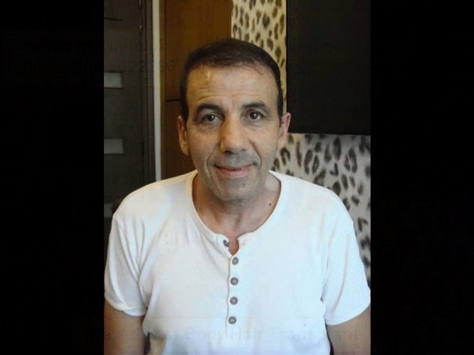 Laser hair Transplant pakistan,Body hair transplant in pakistan,FUE in Gujrat pakistan