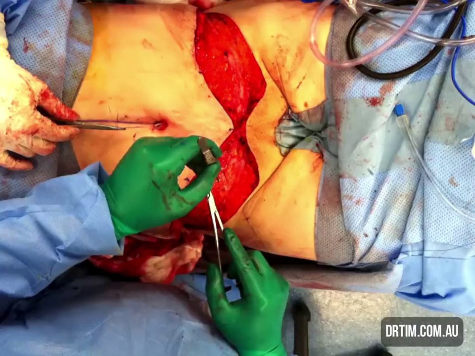 Tummy Tuck For Extreme Stretch Marks _ Muscle Separation on Vimeo