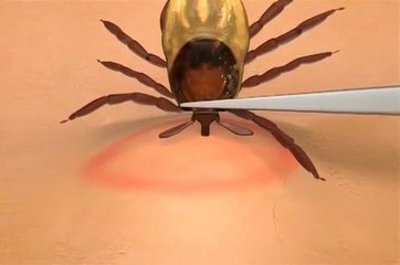 kene vücuttan nasıl çıkarılmalı