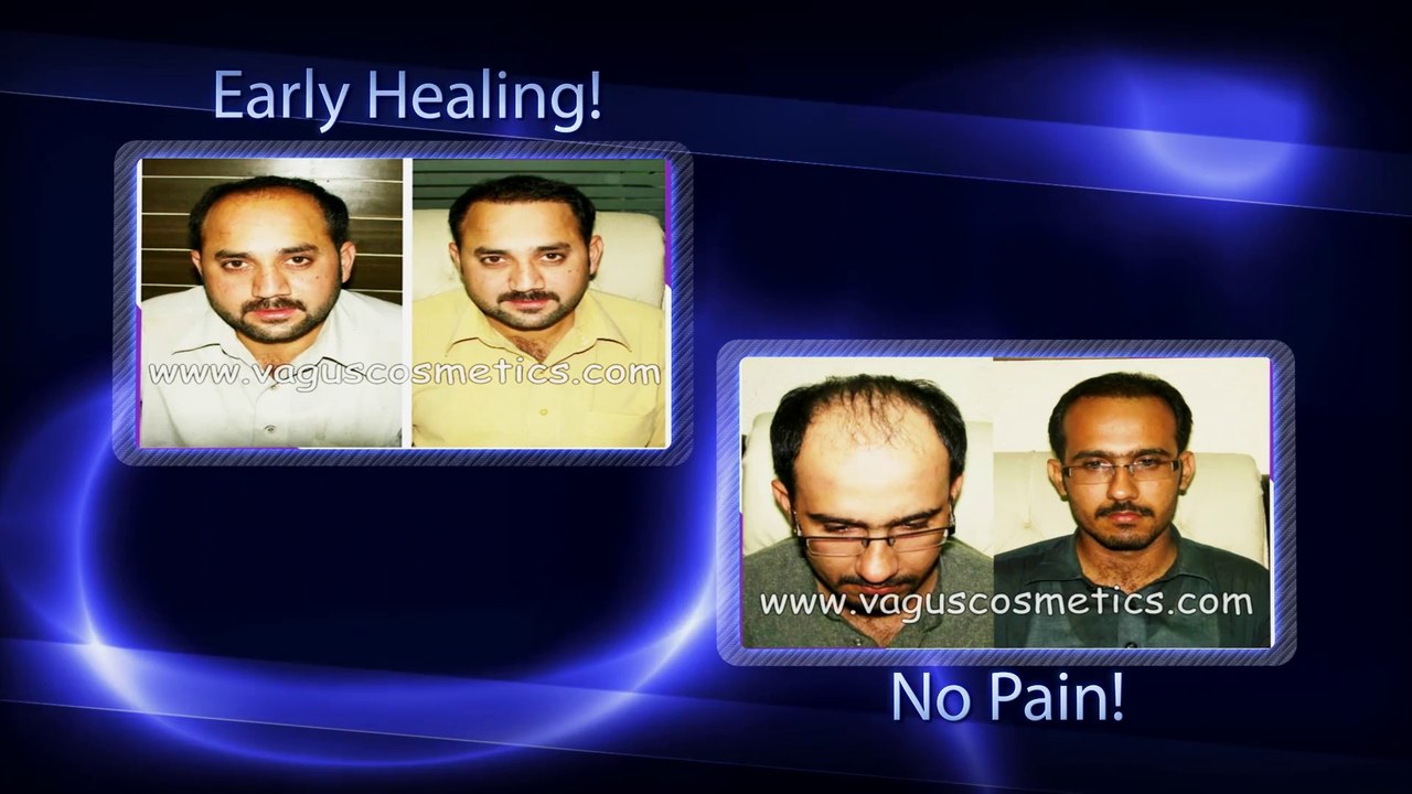 FUE Hair Transplant Before and After Results