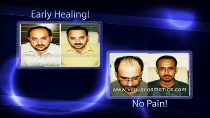 FUE Hair Transplant Before and After Results