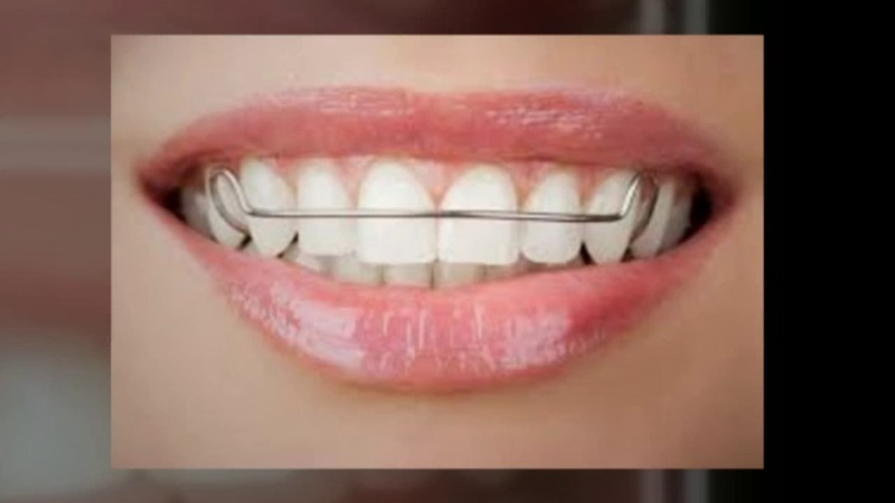 Invisalign Woodland