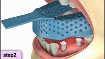 Dental Implants San Francisco CA