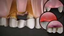Dental Implants Laguna Niguel CA,Dental Implants Laguna Niguel