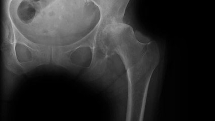 Hip Replacements Shown Through X-Rays - www.totalsportsmedicine.com