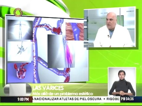 Várices no tratadas pueden provocar un tromboembolismo pulmonar