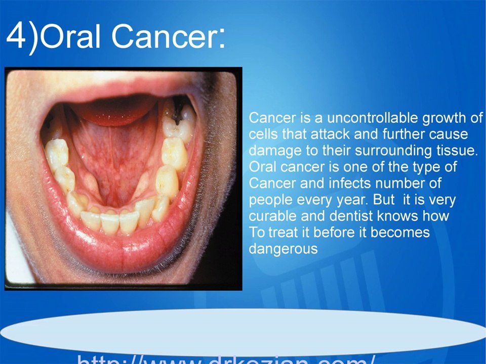 5 Dental Diseases In Adults