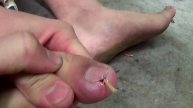 S'enfoncer un cure dent sous les ongles!