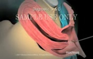 Dilation and currettage