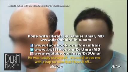 Amazing BHT Hair Surgery Results on Norwood 7 Bald Patient