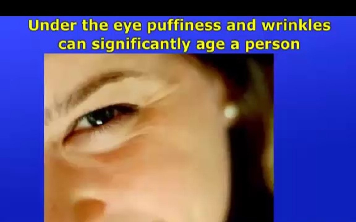 How To Get A Facelift Without Surgery