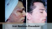 Facial Plastic Surgery of Beaumont Scar Revision Procedures