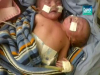 Two headed baby dies in Karachi