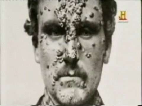 Mercurio en la uretra: Sifilis y gonorrea (Historia)