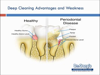 Affordable Gums/ Periodontal Treatment in India
