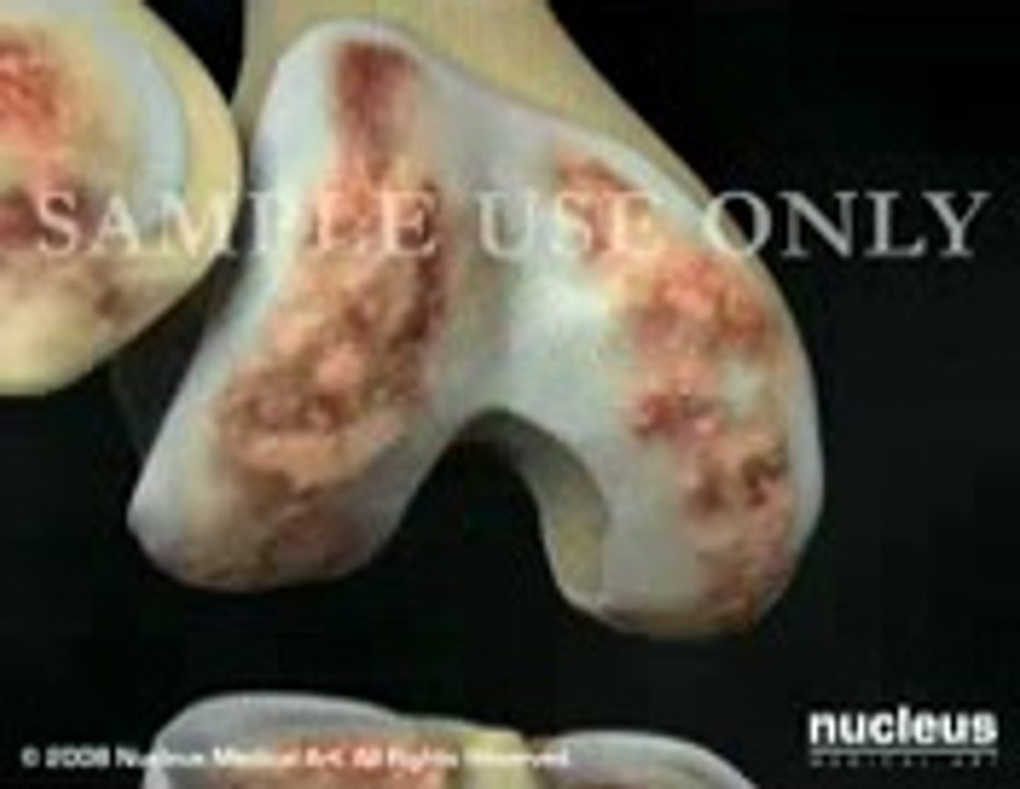 knee replacement surgery