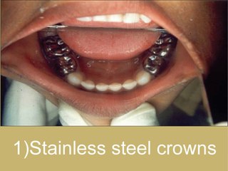 What Are Dental Crowns And Their Types