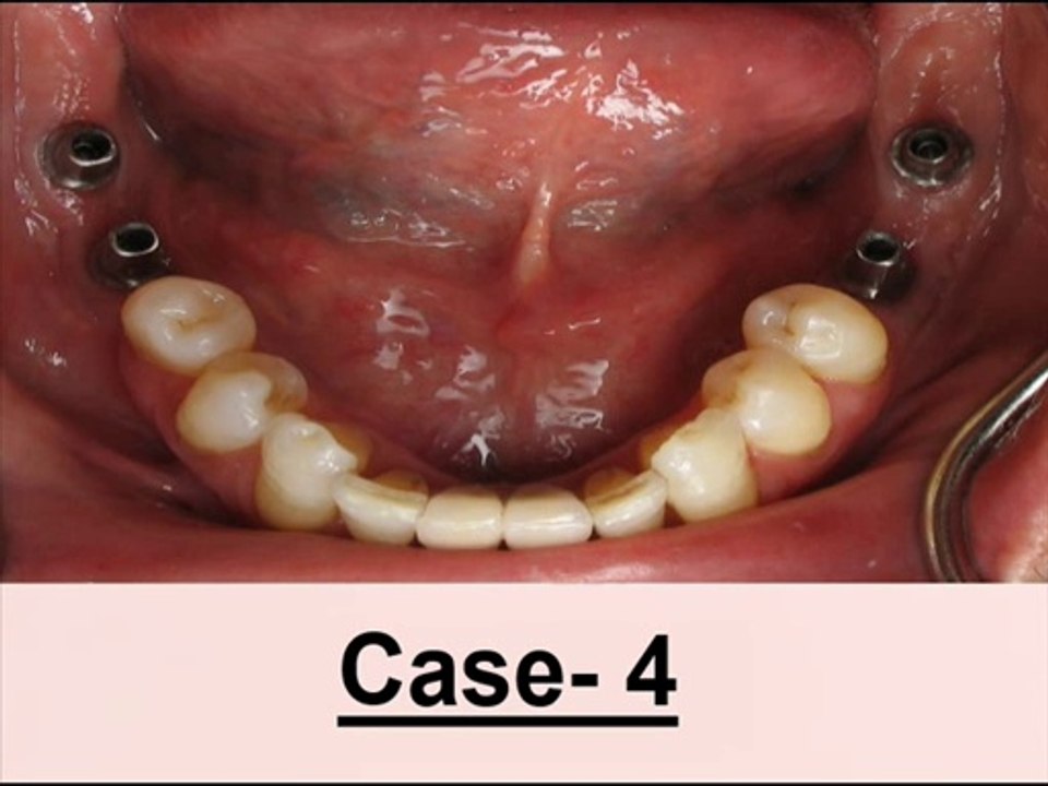 Different Dental Implant Cases