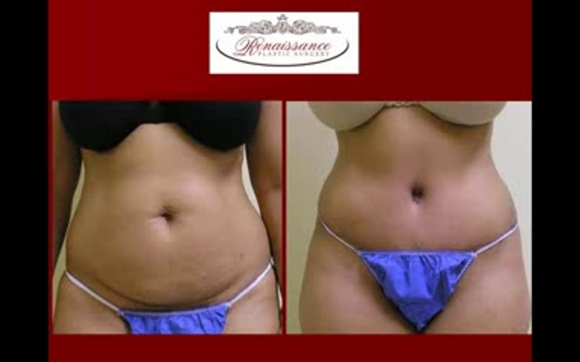 Abdominoplasty or Tummy Tuck at Renaissance Plastic Surgery