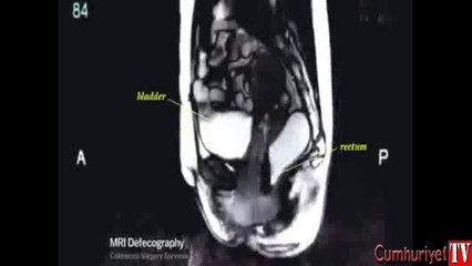 ilk kez öpüşmenin MR'ı çekildi